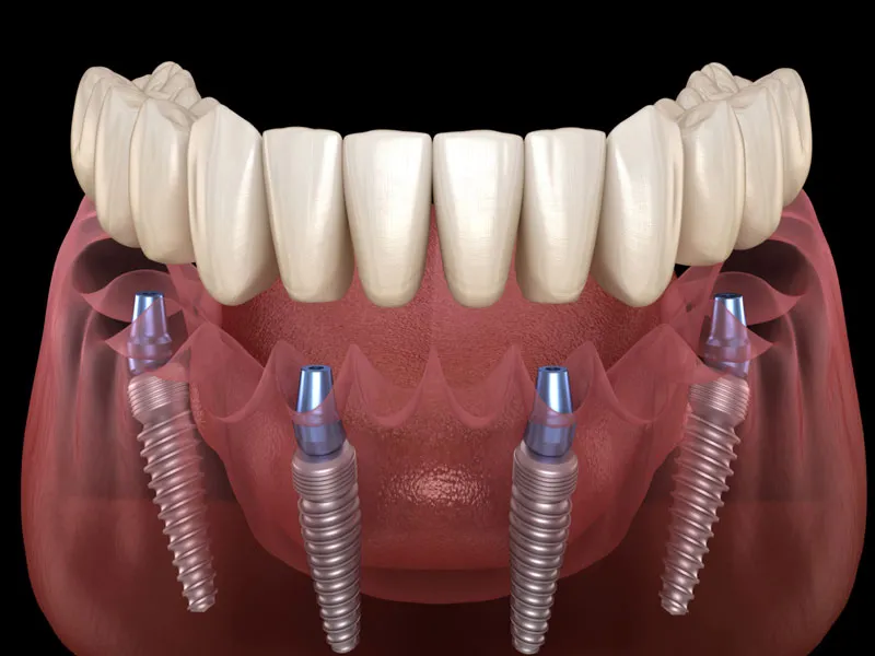 ایمپلنت همه دندان ها به روش all in 4