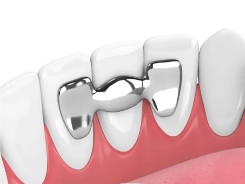 بریج دندان بدون تراش یا بریج مریلند