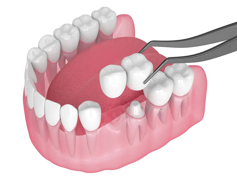 مراحل بریج دندان یک طرفه