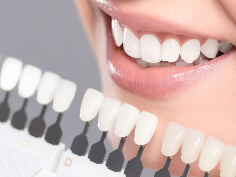 انواع رنگ ایمپلنت دندان