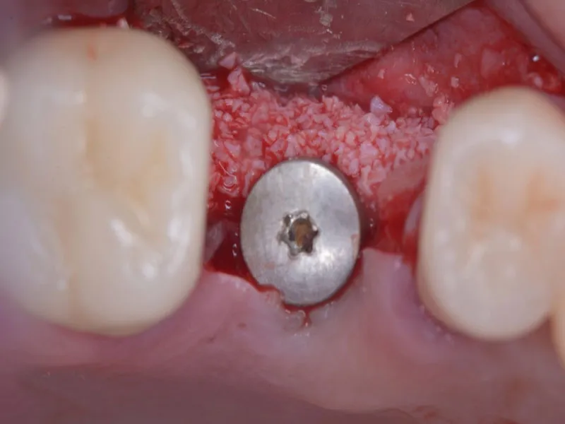 علل بروز عفونت ایمپلنت