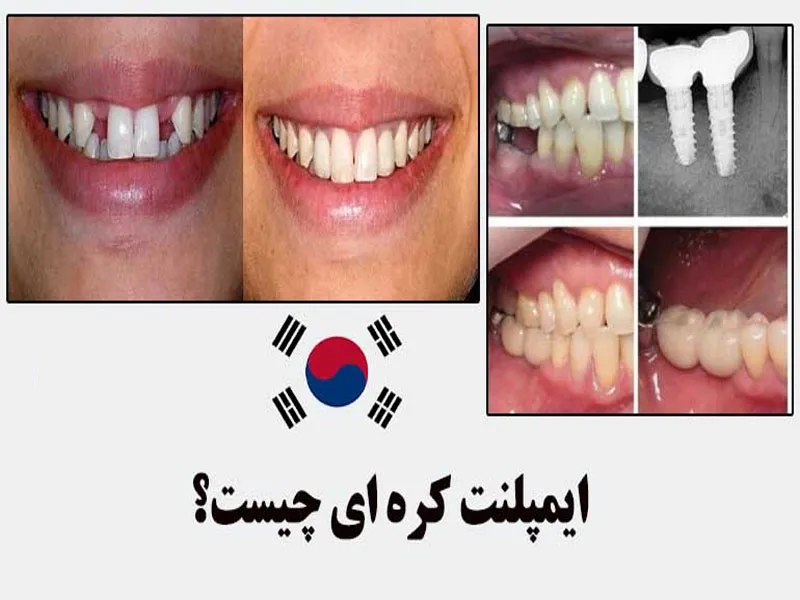 مقایسه ایمپلنت ایرانی و کره ای 1 معرفی ایمپلنت کره ای