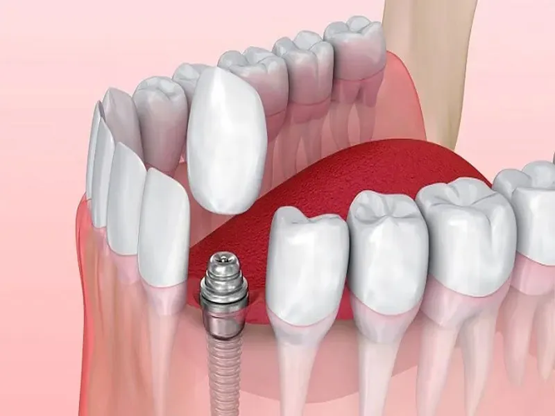 مقایسه ایمپلنت ایرانی و کره ای 2 مقایسه قیمت ایمپلنت ایرانی و کره ای