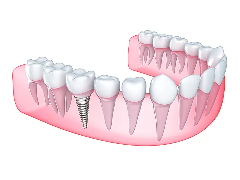 ایمپلنت دندان لترال
