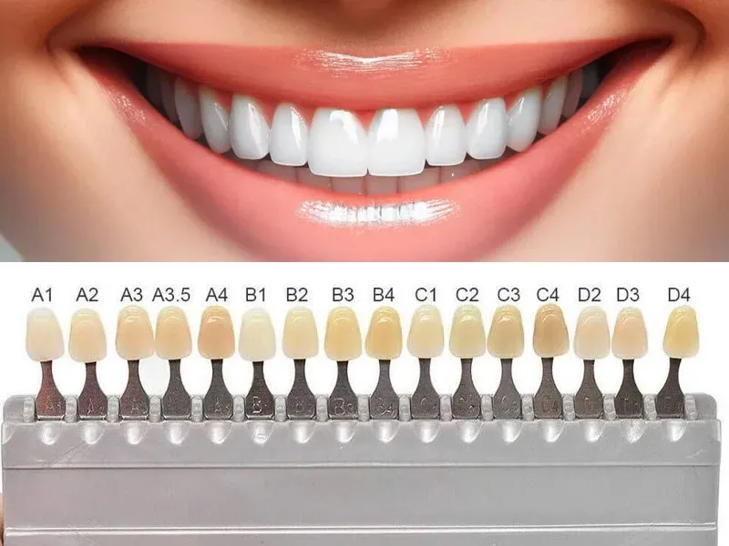 رنگ ایمپلنت دندان