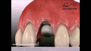 پیوند استخوان در ناحیه ی دندان تازه کشیده شده جهت گذاشتن ایمپلنت در آینده