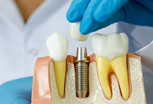 ایمپلنت در مقایسه با سایر روش های جایگزینی دندان