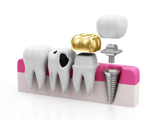 ایمپلنت یا بریج دندان، کدام روش بهتر است؟