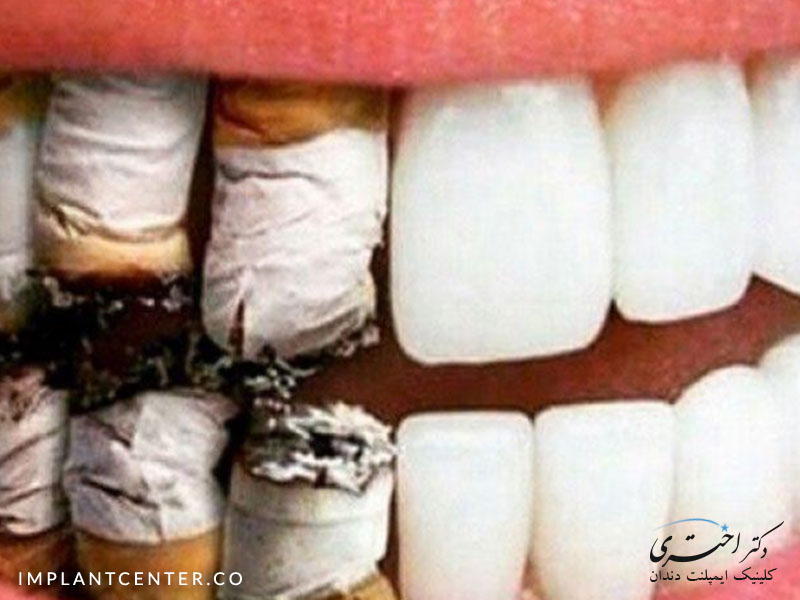 پیامدهای احتمالی استفاده از سیگار و تاثیر آن بر ایمپلنت دندان