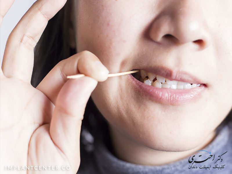 عدم گیر غذایی در دو طرف روکش ایمپلنت